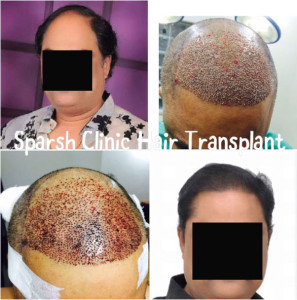 sparsh clinic nashik hair transplant