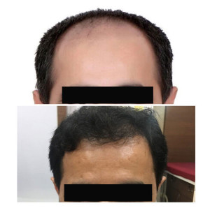 sparsh clinic nashik hair transplant case-15