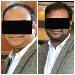 hair-transplant-before-after-case-17