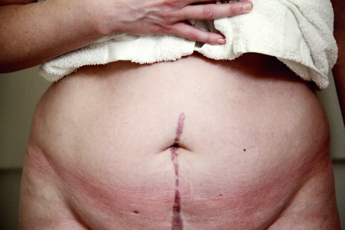 Abdominoplasty — illustrative image