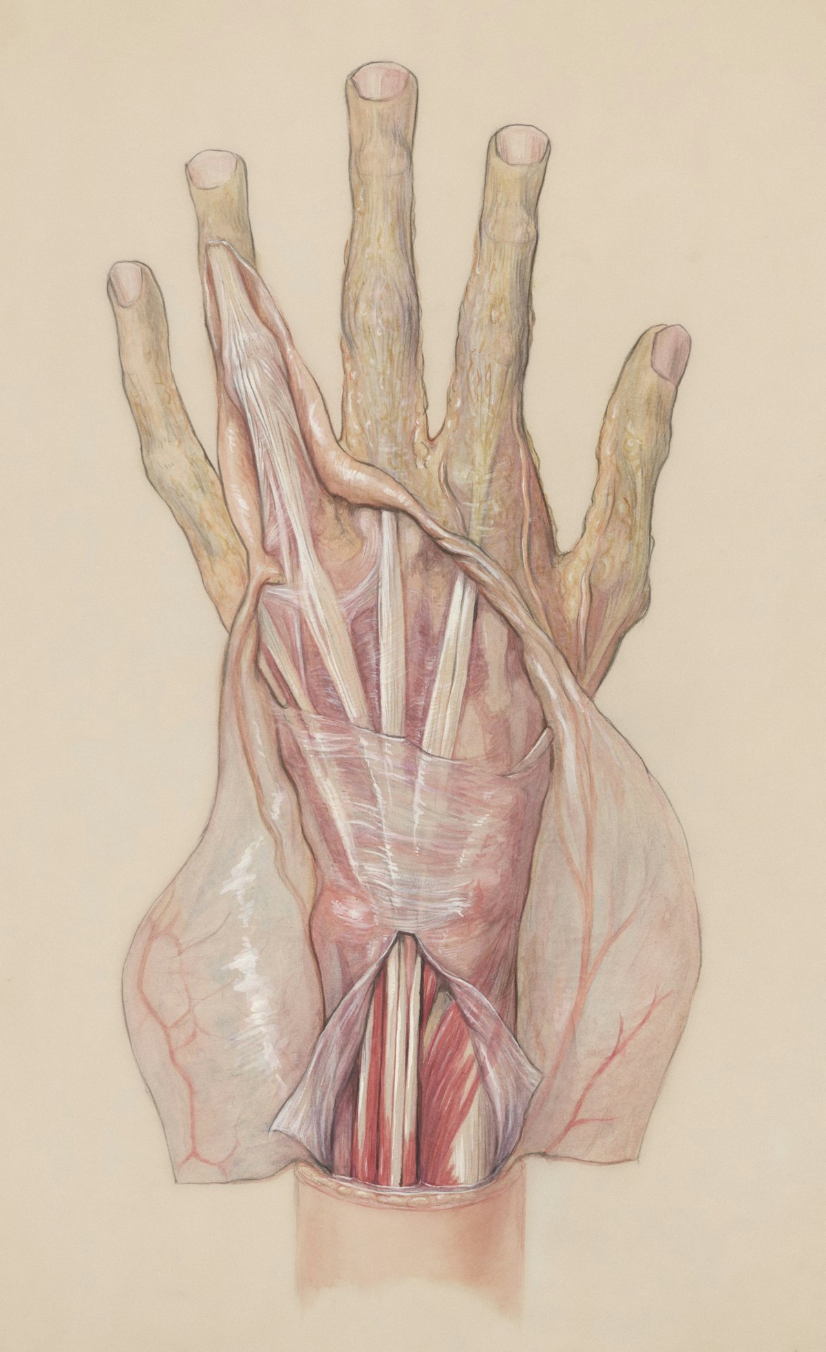 Carpal Tunnel Syndrome — illustrative image